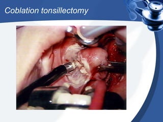 Coblation tonsillectomy
 