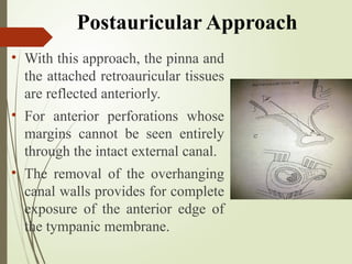 Retroauricular Approach Presentation tympanoplasty by Moushumee.pptx