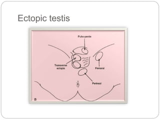 Ectopic testis
 