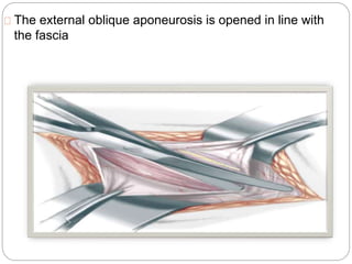 The external oblique aponeurosis is opened in line with
the fascia
 