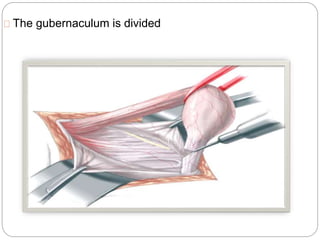 The gubernaculum is divided
 