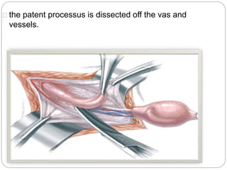 the patent processus is dissected off the vas and
vessels.
 
