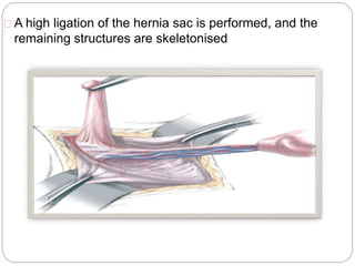 A high ligation of the hernia sac is performed, and the
remaining structures are skeletonised
 