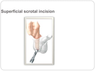 Superficial scrotal incision
 