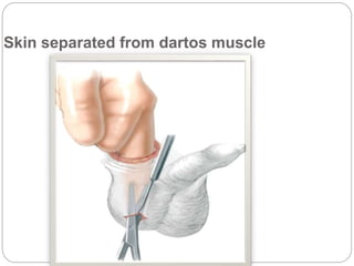 Skin separated from dartos muscle
 