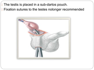 The testis is placed in a sub-dartos pouch.
Fixation sutures to the testes nolonger recommended
 