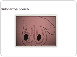 Subdartos pouch
 