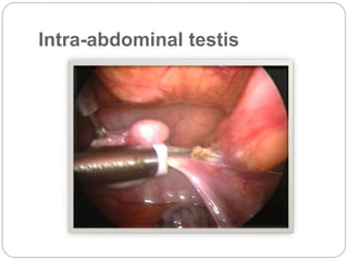 Intra-abdominal testis
 