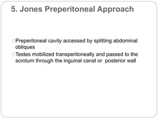 5. Jones Preperitoneal Approach
Preperitoneal cavity accessed by splitting abdominal
obliques
Testes mobilized transperitoneally and passed to the
scrotum through the inguinal canal or posterior wall
 