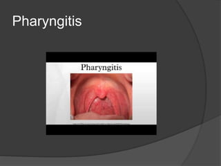Pharyngitis
 