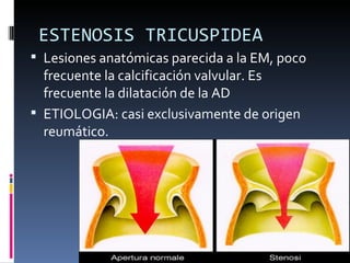 ESTENOSIS TRICUSPIDEA
 Lesiones anatómicas parecida a la EM, poco
  frecuente la calcificación valvular. Es
  frecuente la dilatación de la AD
 ETIOLOGIA: casi exclusivamente de origen
  reumático.
 