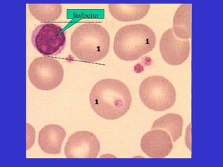 linfocito 