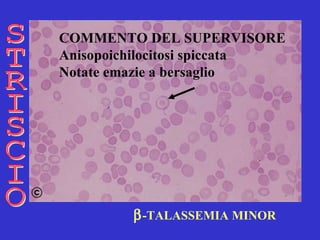  -TALASSEMIA MINOR STRISCIO COMMENTO DEL SUPERVISORE Anisopoichilocitosi spiccata   Notate emazie a bersaglio   