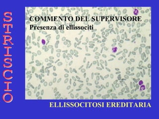 ELLISSOCITOSI EREDITARIA STRISCIO COMMENTO DEL SUPERVISORE Presenza di ellissociti   