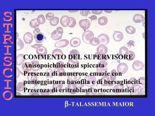  -TALASSEMIA MAIOR STRISCIO COMMENTO DEL SUPERVISORE Anisopoichilocitosi spiccata   Presenza di numerose emazie con  punteggiatura basofila e di bersagliociti.  Presenza di eritroblasti ortocromatici  