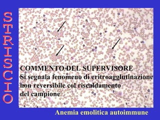 STRISCIO COMMENTO DEL SUPERVISORE Si segnala fenomeno di eritroagglutinazione  non reversibile col riscaldamento  del campione   Anemia emolitica autoimmune 