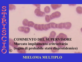 MIELOMA MULTIPLO STRISCIO COMMENTO DEL SUPERVISORE Marcato impilamento eritrocitario (segno di probabile stato disprotidemico)  