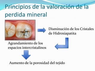 Principios de la valoración de la
perdida mineral
Disminución de los Cristales
de Hidroxiapatita
Agrandamiento de los
espacios intercristalinos

Aumento de la porosidad del tejido

 