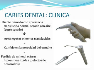 CARIES DENTAL: CLINICA
Diente húmedo con apariencia
translucida normal secado con aire
(corto secado)

Áreas opacas o menos translucidas
=
Cambio en la porosidad del esmalte
=
Perdida de mineral o áreas
hipomineralizadas (defectos de
desarrollos)

 