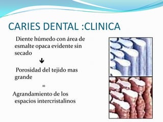 CARIES DENTAL :CLINICA
Diente húmedo con área de
esmalte opaca evidente sin
secado

Porosidad del tejido mas
grande
=
Agrandamiento de los
espacios intercristalinos

 