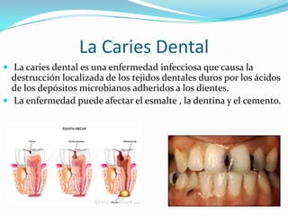 La Caries Dental
 La caries dental es una enfermedad infecciosa que causa la

destrucción localizada de los tejidos dentales duros por los ácidos
de los depósitos microbianos adheridos a los dientes.
 La enfermedad puede afectar el esmalte , la dentina y el cemento.

 