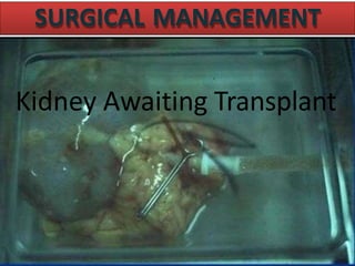 SURGICAL MANAGEMENT
Kidney Awaiting Transplant
 