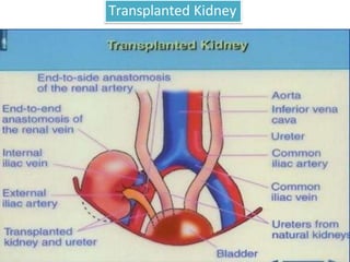 Transplanted Kidney
 