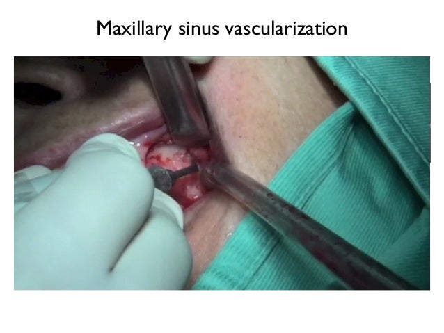 Sinus Lift And Immediate Implant Placement