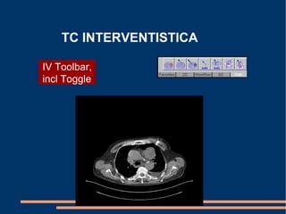 TC INTERVENTISTICA
IV Toolbar,
incl Toggle
 