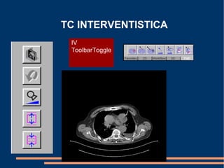 TC INTERVENTISTICA
IV
ToolbarToggle
 