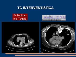 TC INTERVENTISTICA
IV Toolbar,
incl Toggle
 