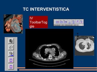 TC INTERVENTISTICA
IV
ToolbarTog
gle
V
G
T
 