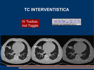 TC INTERVENTISTICA
IV Toolbar,
incl Toggle
 