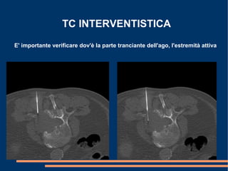TC INTERVENTISTICA
E' importante verificare dov'è la parte tranciante dell'ago, l'estremità attiva
 