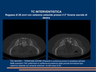 TC INTERVENTISTICA
Ragazza di 26 anni con osteoma osteoide presso il 2° forame sacrale di
destra
TAC BACINO – TERMOABLAZIONE (Paziente in posizione prona in anestesia spinale)
Nelle scansioni TAC preliminari si conferma la presenza della piccola formazione tipo
osteoma osteoide sul versante anteriore dx del corpo di S2
 