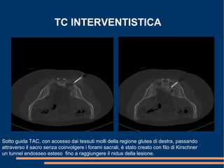 TC INTERVENTISTICA
Sotto guida TAC, con accesso dai tessuti molli della regione glutea di destra, passando
attraverso il sacro senza coinvolgere i forami sacrali, è stato creato con filo di Kirschner
un tunnel endosseo esteso fino a raggiungere il nidus della lesione.
 