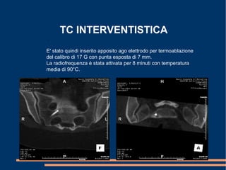 TC INTERVENTISTICA
.
E' stato quindi inserito apposito ago elettrodo per termoablazione
del calibro di 17 G con punta esposta di 7 mm.
La radiofrequenza è stata attivata per 8 minuti con temperatura
media di 90°C.
 