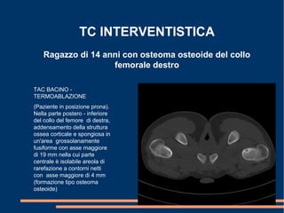 TC INTERVENTISTICA
Ragazzo di 14 anni con osteoma osteoide del collo
femorale destro
TAC BACINO -
TERMOABLAZIONE
(Paziente in posizione prona).
Nella parte postero - inferiore
del collo del femore di destra,
addensamento della struttura
ossea corticale e spongiosa in
un'area grossolanamente
fusiforme con asse maggiore
di 19 mm nella cui parte
centrale è isolabile areola di
rarefazione a contorni netti
con asse maggiore di 4 mm
(formazione tipo osteoma
osteoide)
 