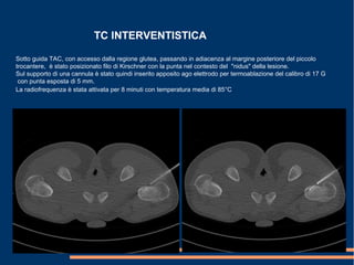 TC INTERVENTISTICA
Sotto guida TAC, con accesso dalla regione glutea, passando in adiacenza al margine posteriore del piccolo
trocantere, è stato posizionato filo di Kirschner con la punta nel contesto del "nidus" della lesione.
Sul supporto di una cannula è stato quindi inserito apposito ago elettrodo per termoablazione del calibro di 17 G
con punta esposta di 5 mm.
La radiofrequenza è stata attivata per 8 minuti con temperatura media di 85°C
 