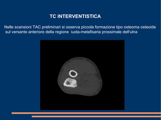 TC INTERVENTISTICA
Nelle scansioni TAC preliminari si osserva piccola formazione tipo osteoma osteoide
sul versante anteriore della regione iuxta-metafisaria prossimale dell'ulna
 