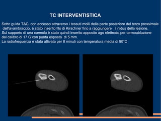 TC INTERVENTISTICA
Sotto guida TAC, con accesso attraverso i tessuti molli della parte posteriore del terzo prossimale
dell'avambraccio, è stato inserito filo di Kirschner fino a raggiungere il nidus della lesione.
Sul supporto di una cannula è stato quindi inserito apposito ago elettrodo per termoablazione
del calibro di 17 G con punta esposta di 5 mm.
La radiofrequenza è stata attivata per 8 minuti con temperatura media di 90°C
 