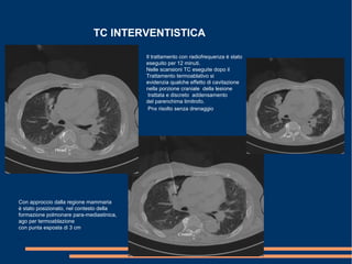 TC INTERVENTISTICA
Con approccio dalla regione mammaria
è stato posizionato, nel contesto della
formazione polmonare para-mediastinica,
ago per termoablazione
con punta esposta di 3 cm.
.
Il trattamento con radiofrequenza è stato
eseguito per 12 minuti.
Nelle scansioni TC eseguite dopo il
Trattamento termoablativo si
evidenzia qualche effetto di cavitazione
nella porzione craniale della lesione
trattata e discreto addensamento
del parenchima limitrofo.
Pnx risolto senza drenaggio
 