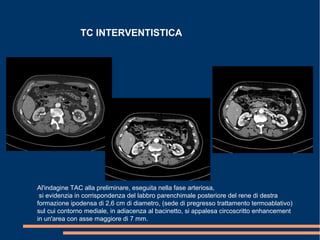 TC INTERVENTISTICA
Al'indagine TAC alla preliminare, eseguita nella fase arteriosa,
si evidenzia in corrispondenza del labbro parenchimale posteriore del rene di destra
formazione ipodensa di 2,6 cm di diametro, (sede di pregresso trattamento termoablativo)
sul cui contorno mediale, in adiacenza al bacinetto, si appalesa circoscritto enhancement
in un'area con asse maggiore di 7 mm.
 