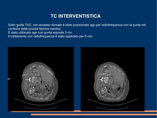 TC INTERVENTISTICA
Sotto guida TAC, con accesso dorsale è stato posizionato ago per radiofrequenza con la punta nel
contesto della piccola lesione residua.
È stato utilizzato ago con punta esposta 3 cm.
Il trattamento con radiofrequenza è stato applicato per 8 min.
 
