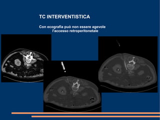 TC INTERVENTISTICA
Con ecografia può non essere agevole
l'accesso retroperitonetale
 