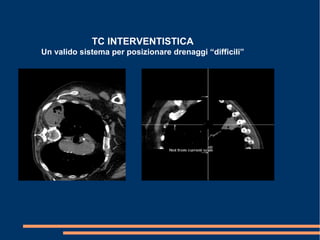 TC INTERVENTISTICA
Un valido sistema per posizionare drenaggi “difficili”
 