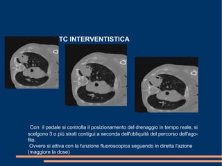 TC INTERVENTISTICA
Con il pedale si controlla il posizionamento del drenaggio in tempo reale, si
scelgono 3 o più strati contigui a seconda dell'obliquità del percorso dell'ago-
filo.
Ovvero si attiva con la funzione fluoroscopica seguendo in diretta l'azione
(maggiore la dose)
 