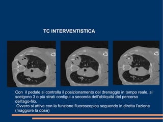 TC INTERVENTISTICA
Con il pedale si controlla il posizionamento del drenaggio in tempo reale, si
scelgono 3 o più strati contigui a seconda dell'obliquità del percorso
dell'ago-filo.
Ovvero si attiva con la funzione fluoroscopica seguendo in diretta l'azione
(maggiore la dose)
 