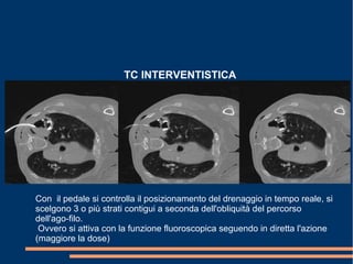 TC INTERVENTISTICA
Con il pedale si controlla il posizionamento del drenaggio in tempo reale, si
scelgono 3 o più strati contigui a seconda dell'obliquità del percorso
dell'ago-filo.
Ovvero si attiva con la funzione fluoroscopica seguendo in diretta l'azione
(maggiore la dose)
 