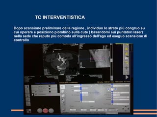 TC INTERVENTISTICA
Dopo scansione preliminare della regione , individuo lo strato più congruo su
cui operare e posiziono piombino sulla cute ( basandomi sui puntatori laser)
nella sede che reputo più comoda all'ingresso dell'ago ed eseguo scansione di
controllo
 